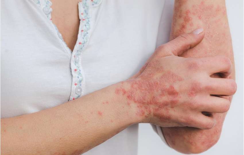How to prevent the recurrence of psoriasis skin disease