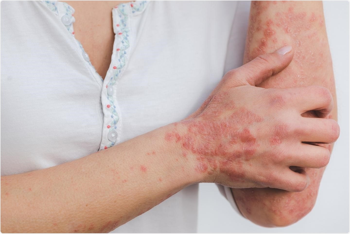 How to prevent the recurrence of psoriasis skin disease