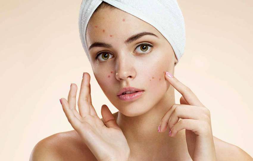 How to deal with monsoon acne?