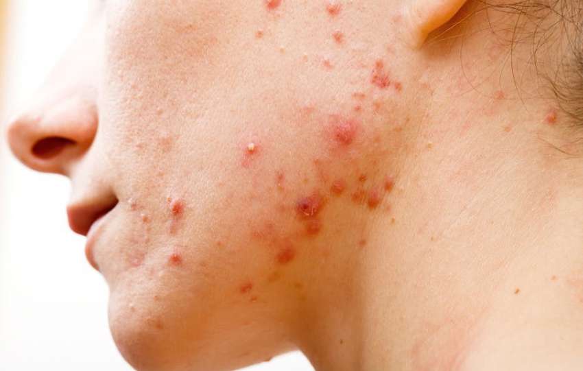 Does skin stress lead to pimples?