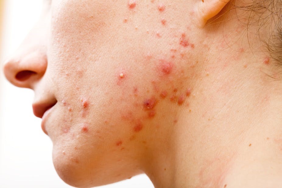 Does skin stress lead to pimples?