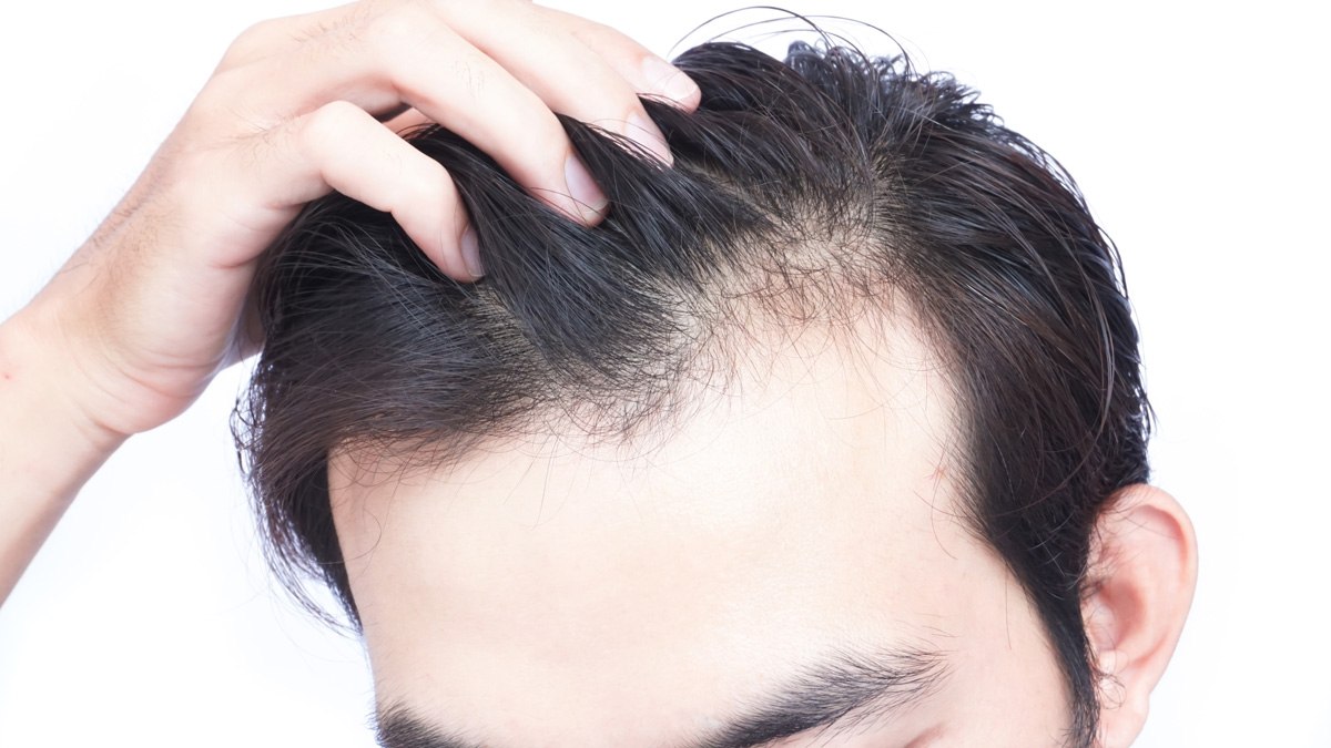 Different types of hair loss and treatment options
