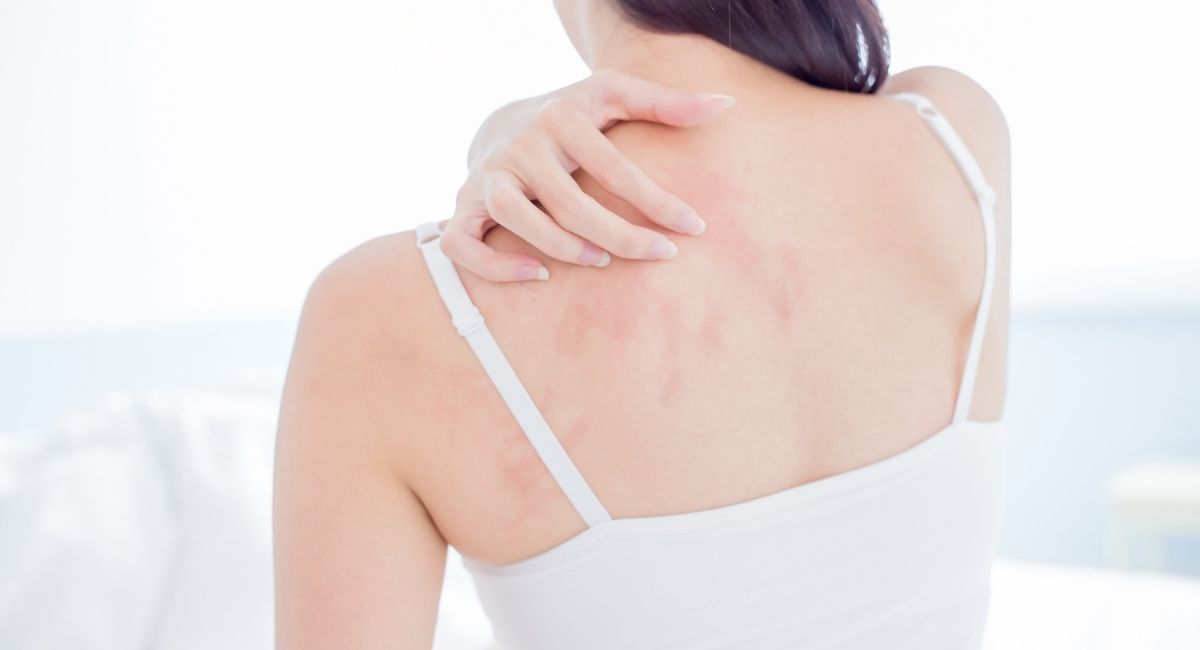 10 Tricks To Avoid Eczema Flares