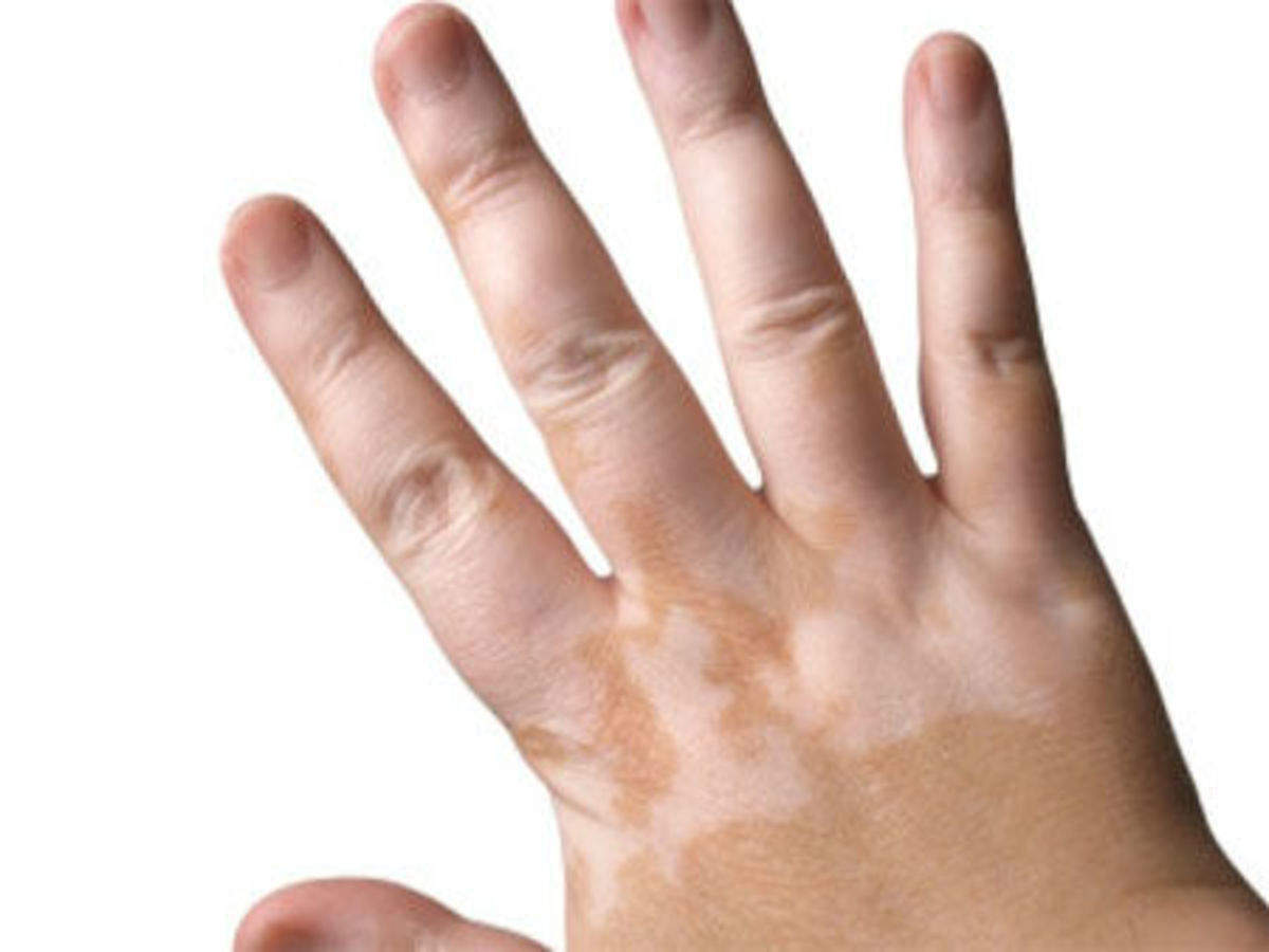 12 Best Tips On How To Treat Vitiligo