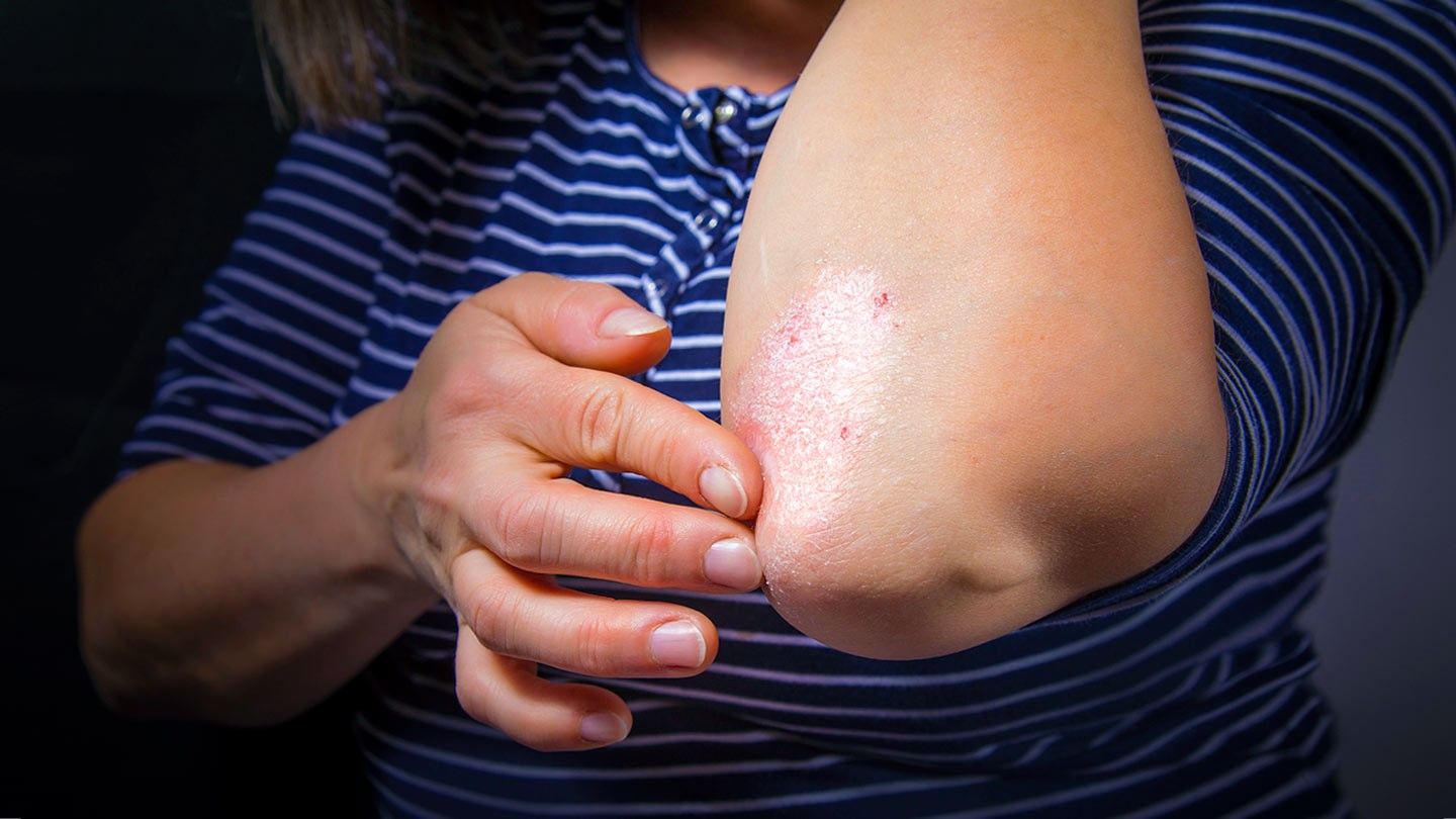 7 Signs You Have Psoriasis