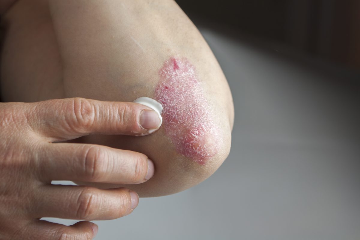 How To Find Best Skin Doctor For Psoriasis