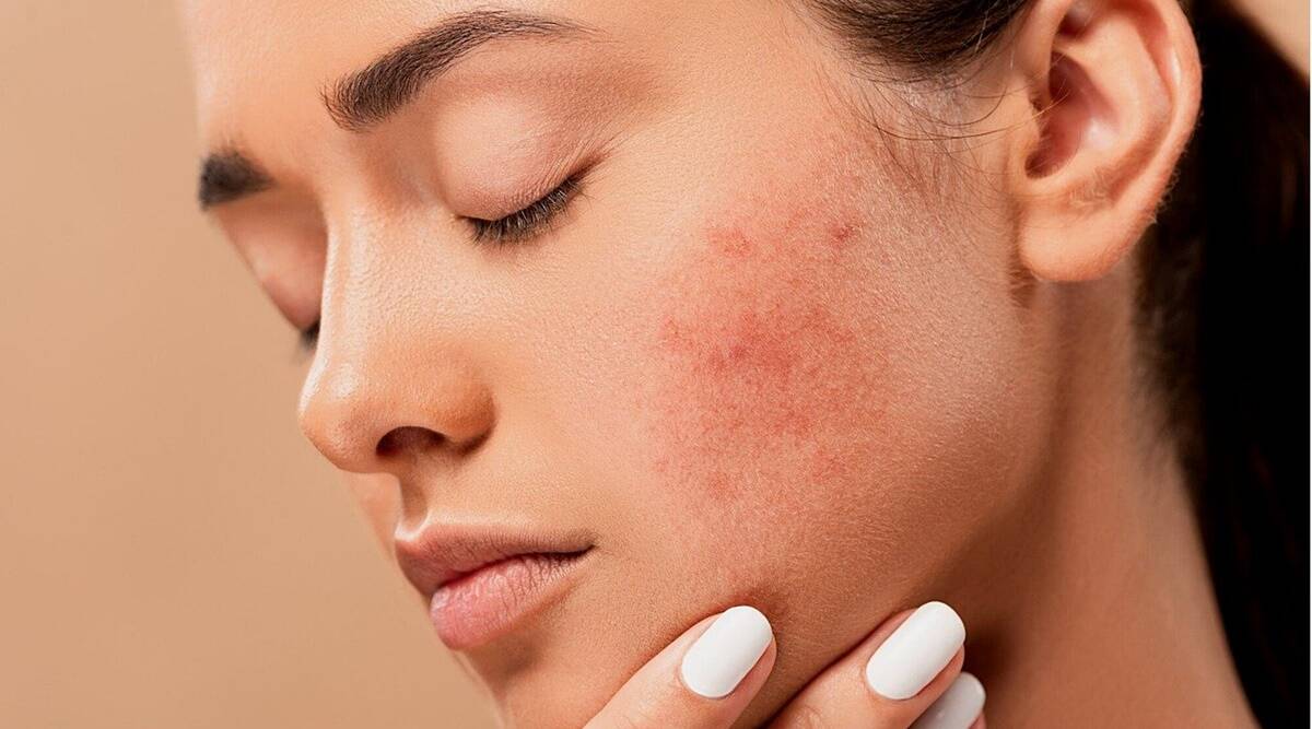 How To Reduce Acne Redness