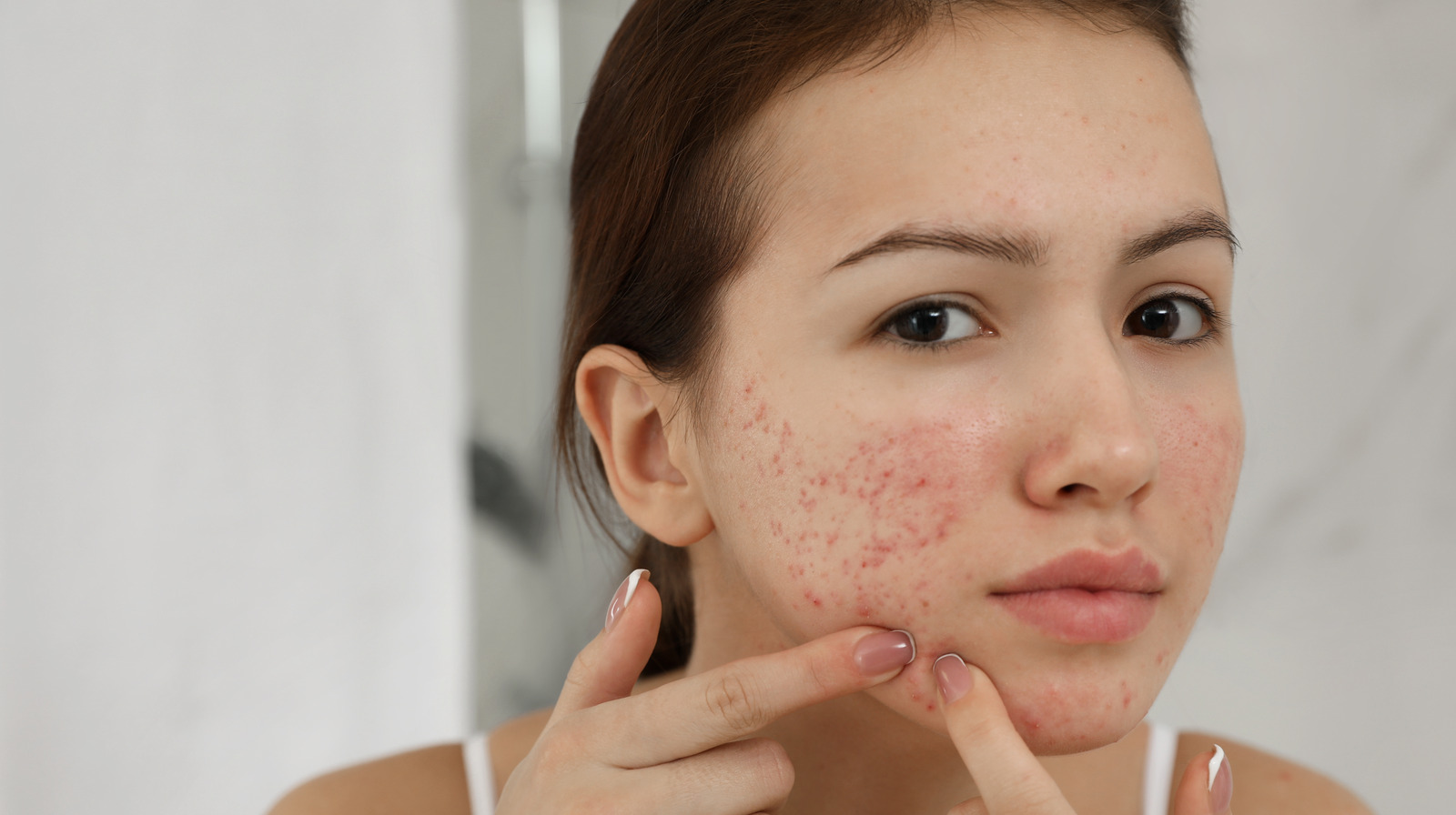 How To Tell If You Have Acne