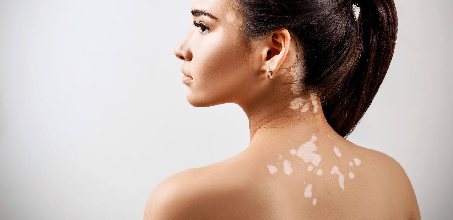 How to Find The Best Skin Doctor For Vitiligo