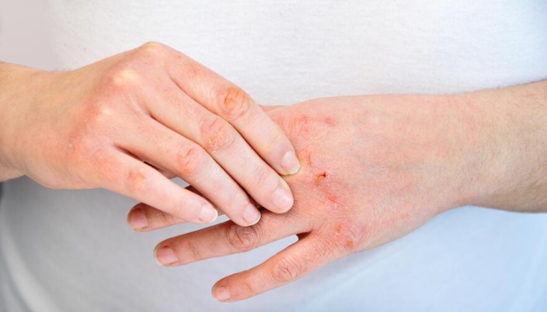 Home remedies to cure Psoriasis