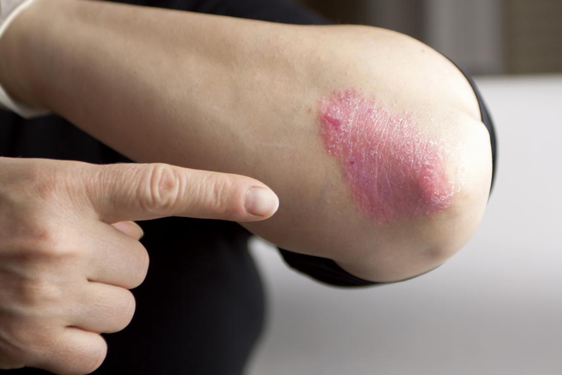 Psoriasis and red rashes on skin