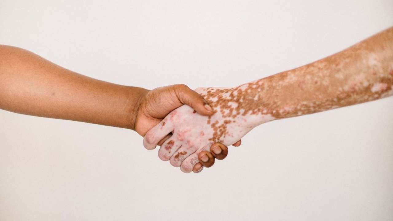 Vitiligo Is A Genetic Disease
