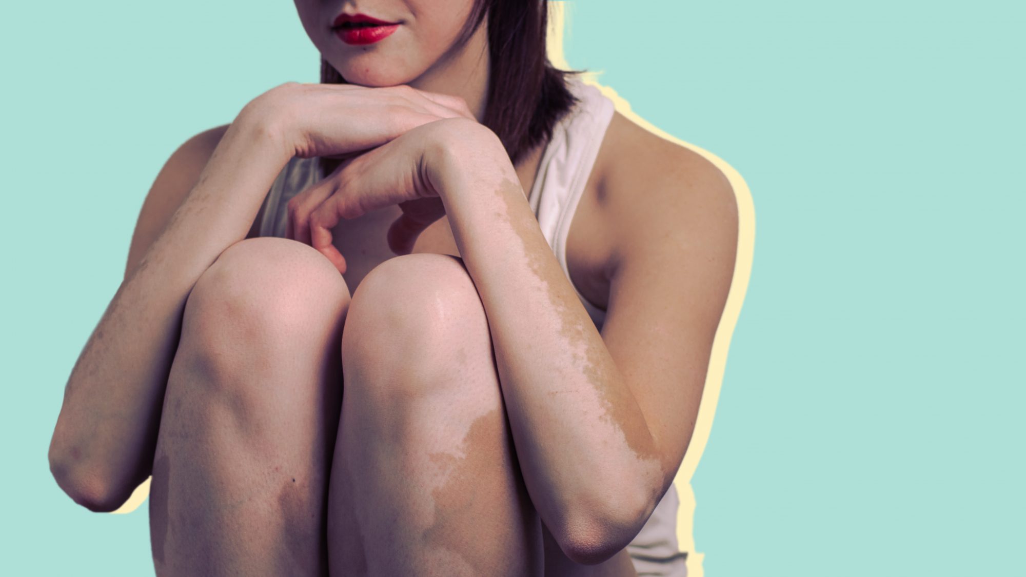 Vitiligo - Symptoms, Causes & Treatment by Skin Doctor