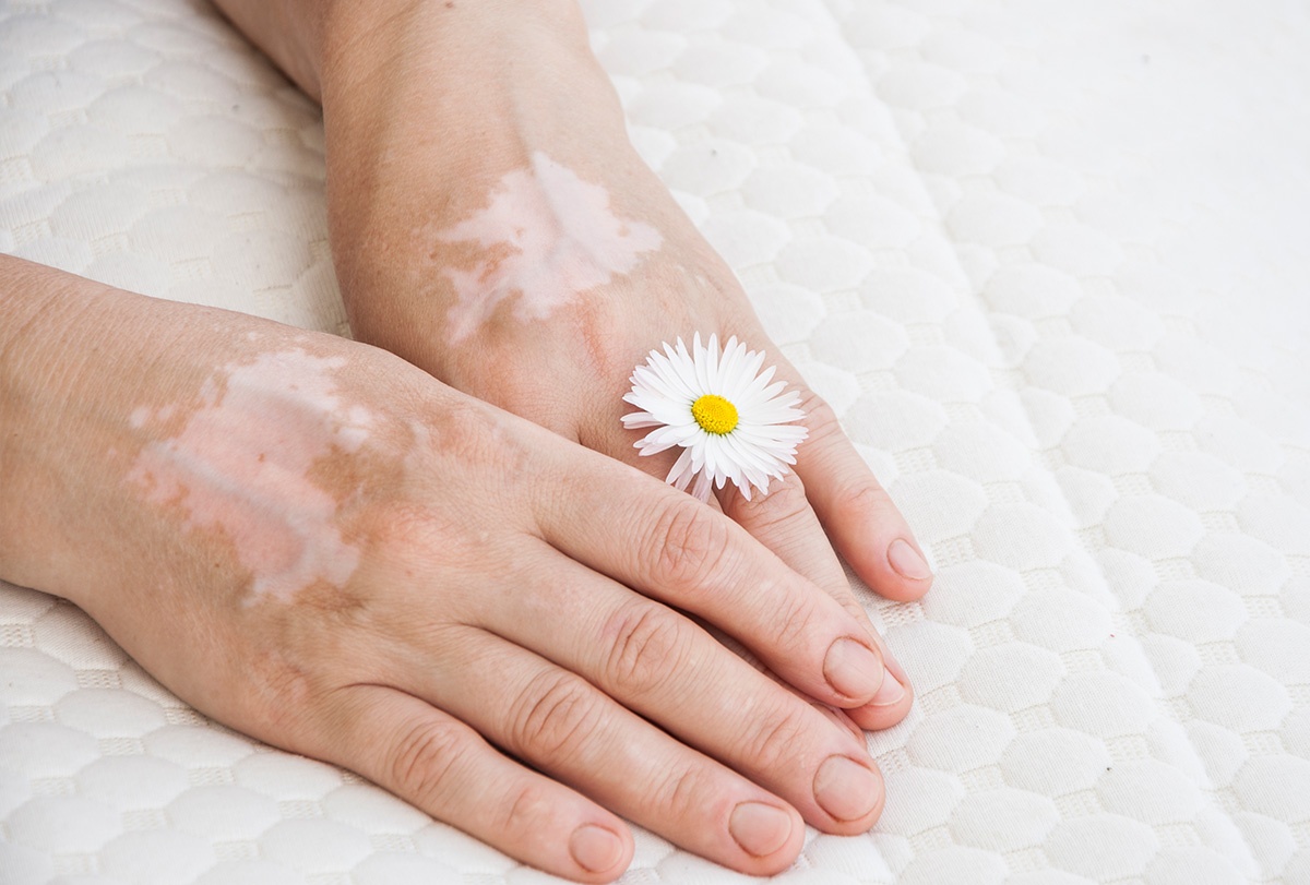 Vitiligo & White Patches On Skin