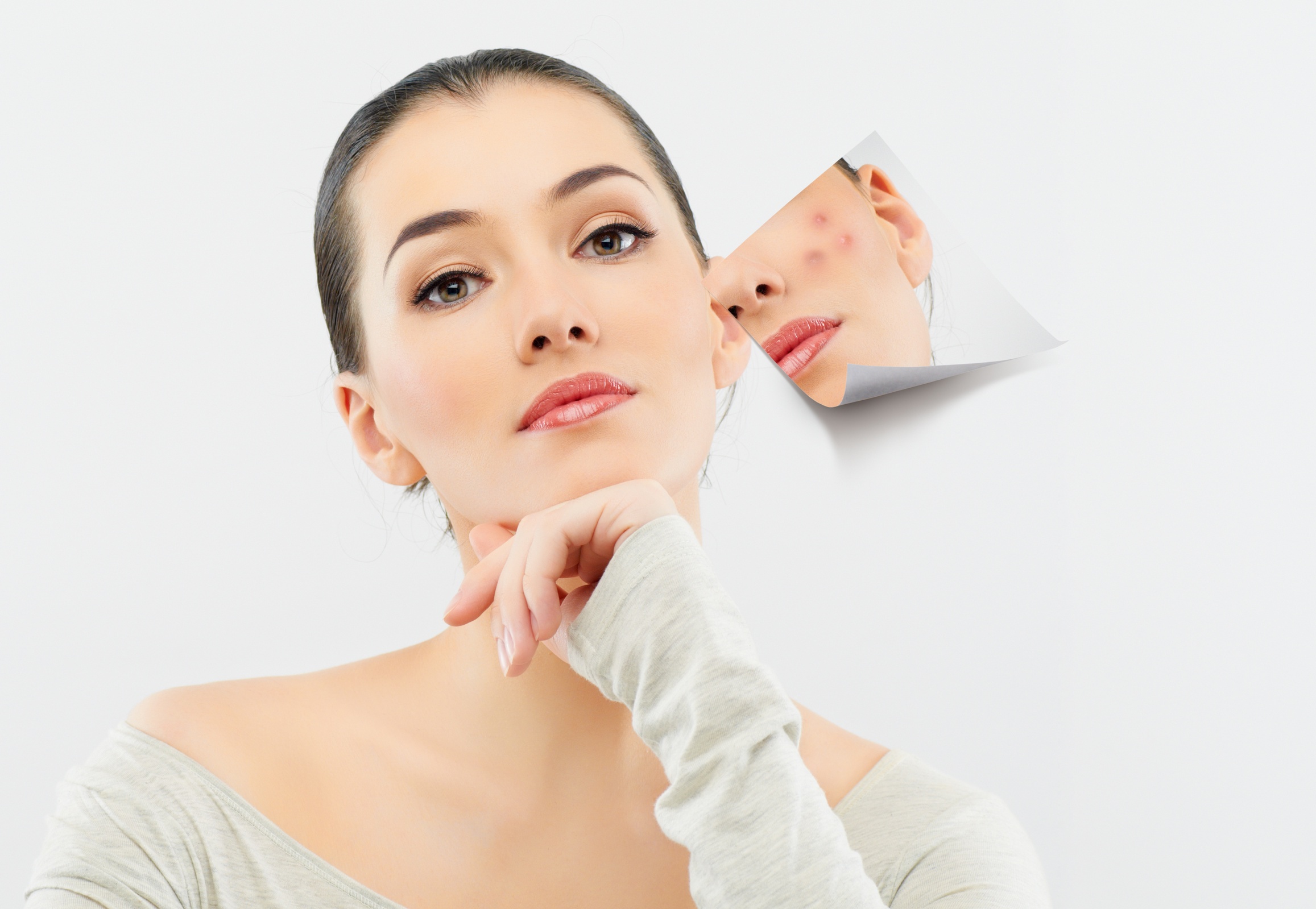 What Do You Need To Know Before Starting Acne Treatment