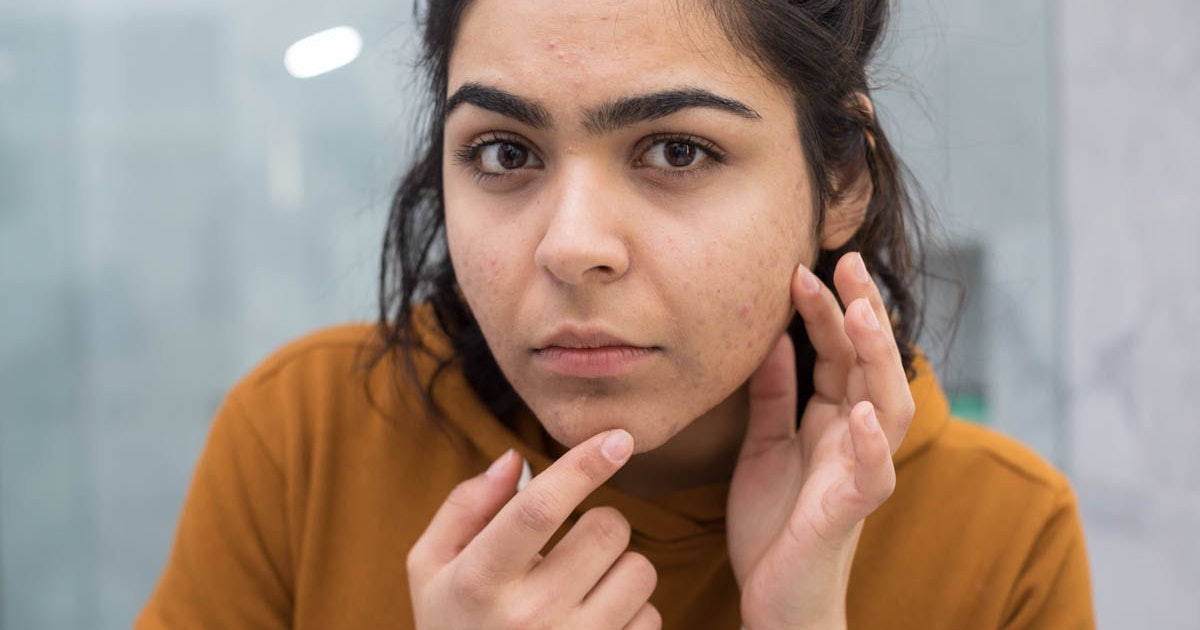 What To Do With Sudden Acne Breakouts