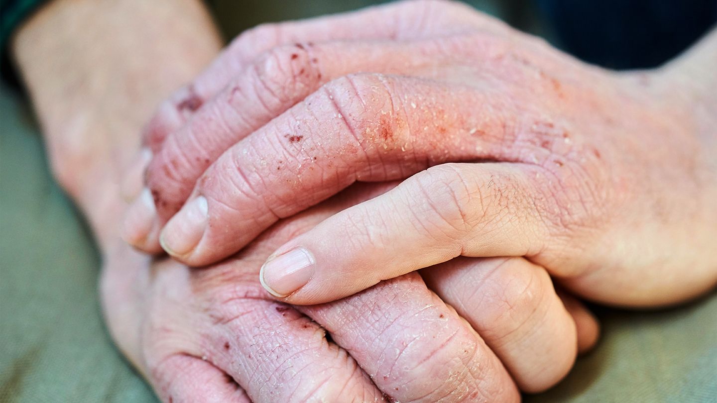 What You Should Know About Eczema