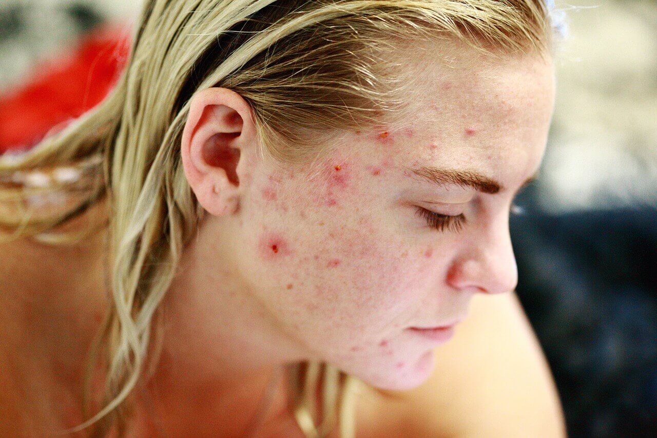 Why Does Acne Affect Some People More Than Others