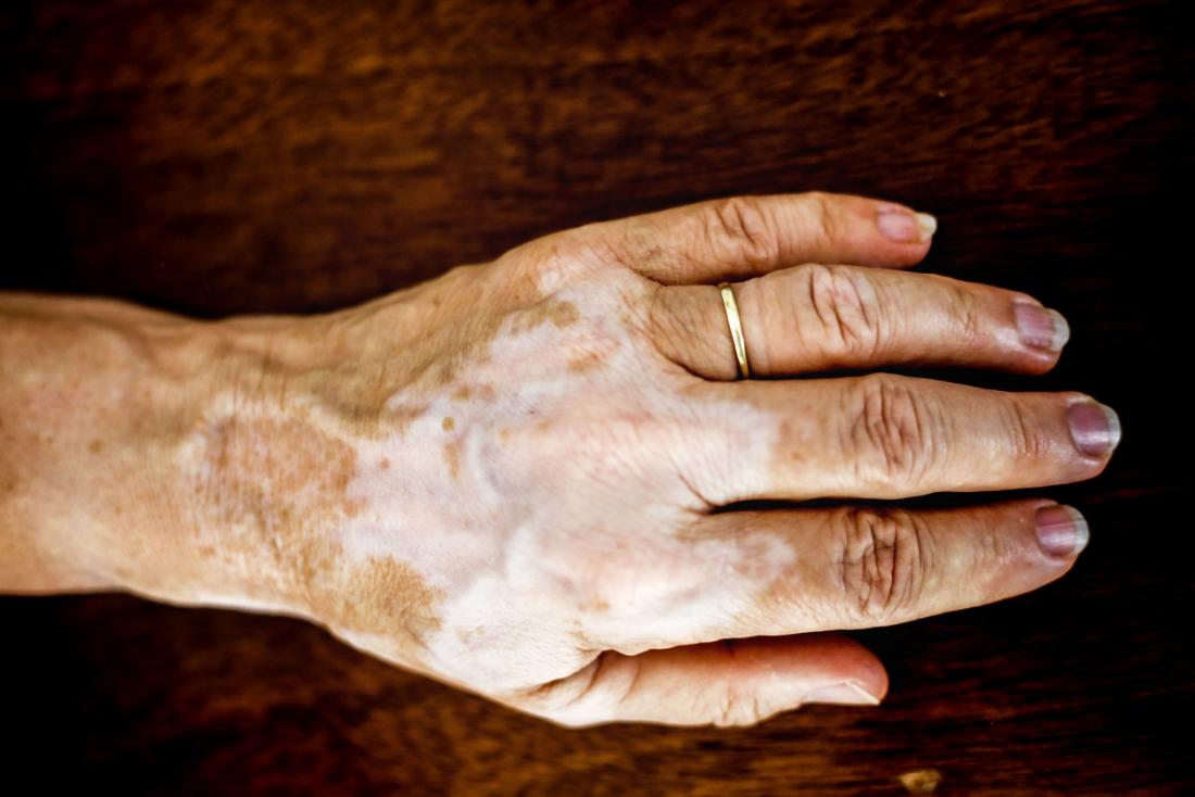 does vitiligo itch