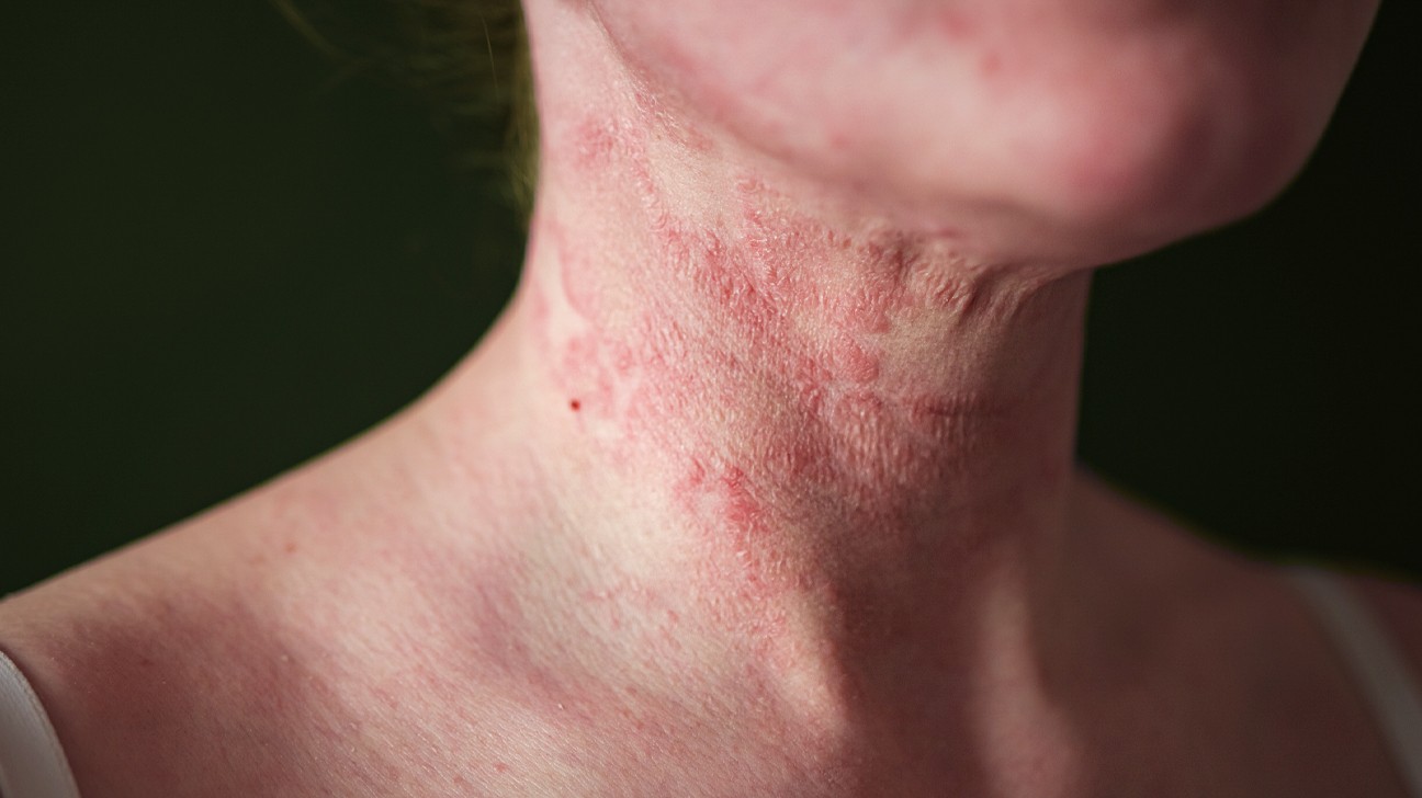 10 Signs You May Have Severe Eczema