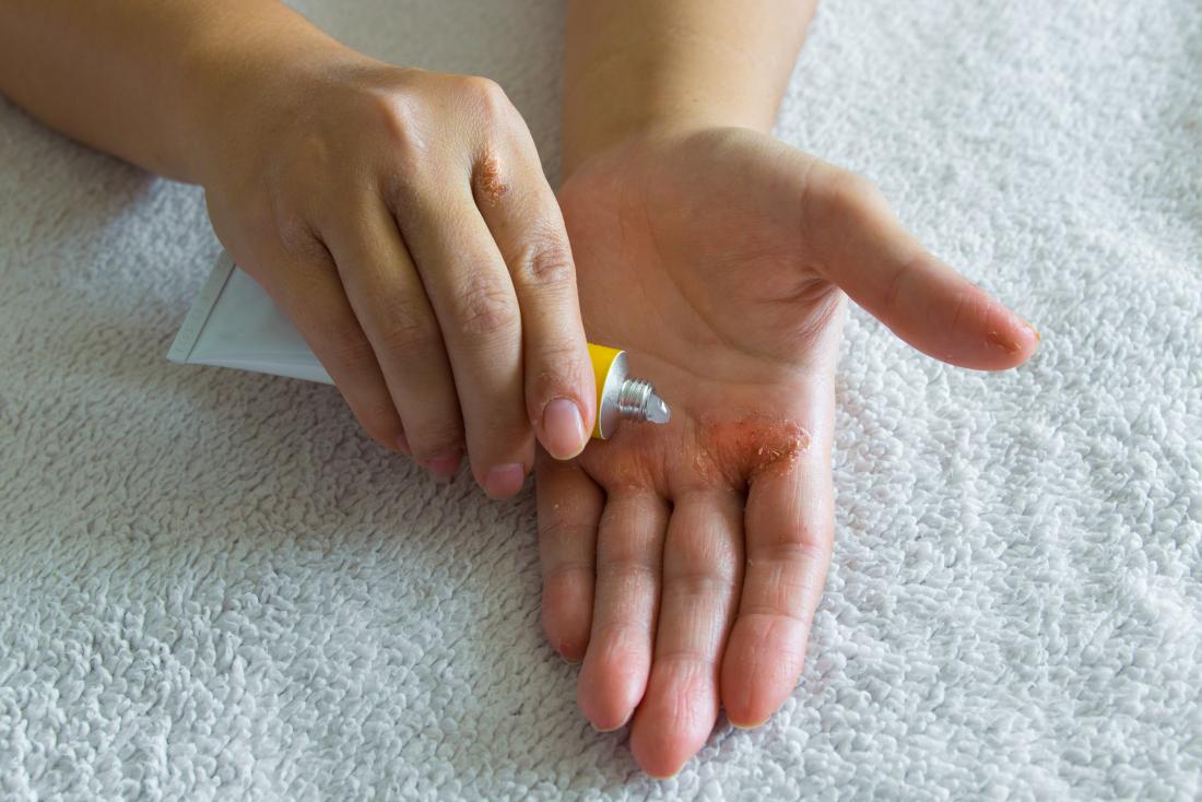 13 Effective Ways To Treat Severe Eczema