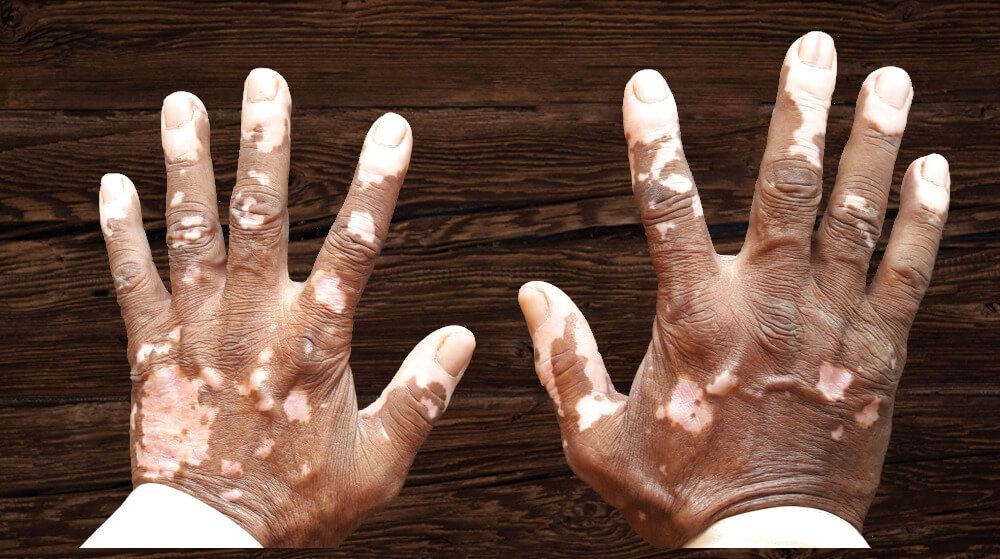 A Holistic Guide To Treatment For Vitiligo