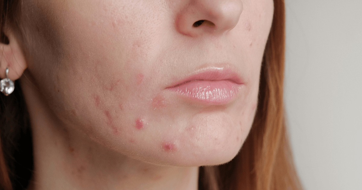 All about perimenopause acne