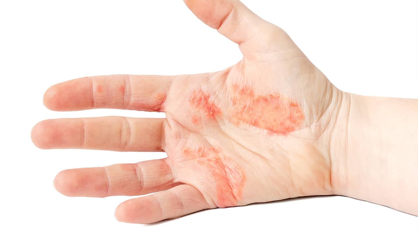 Can Eczema Cause Other Health Problems