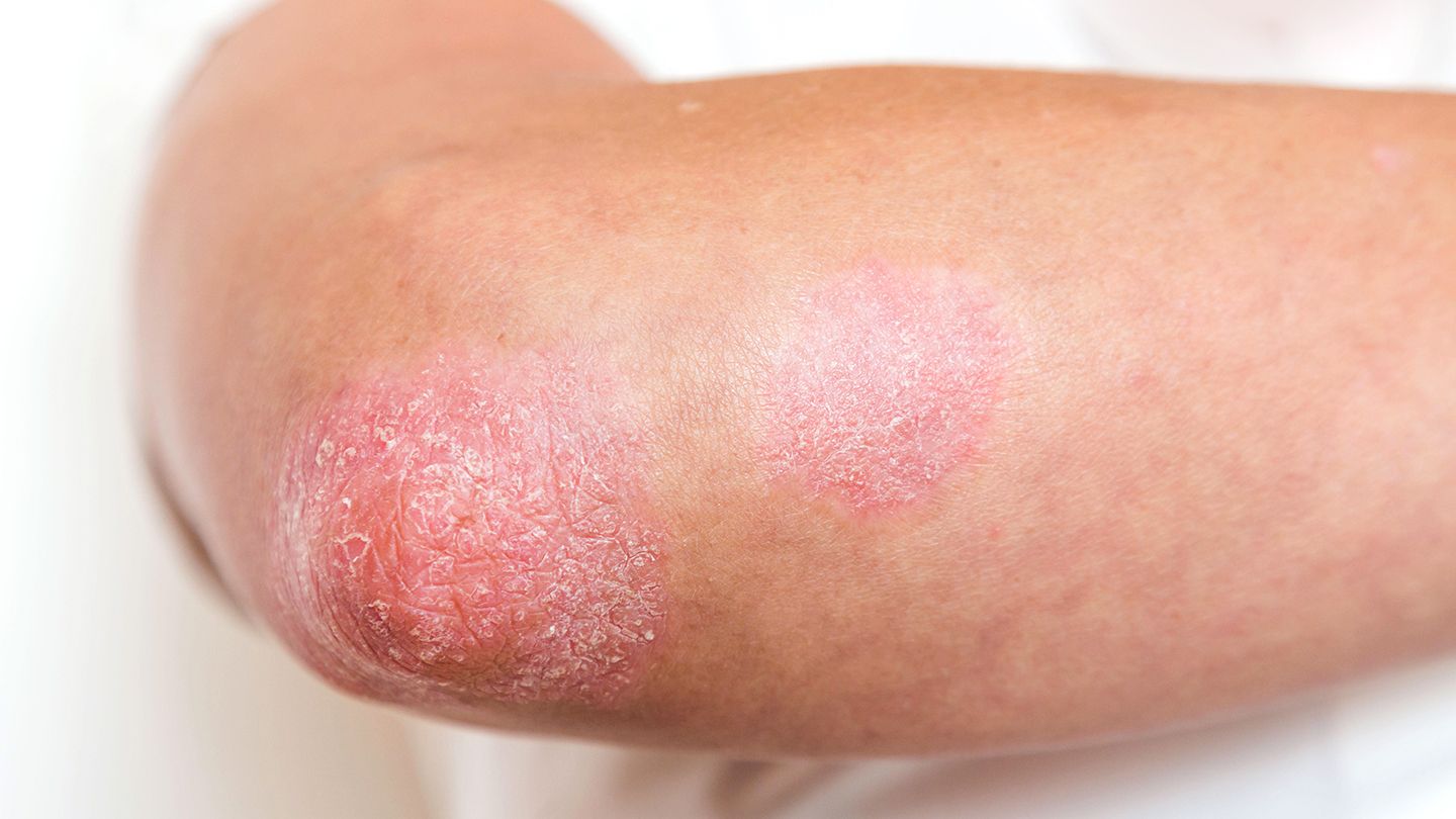 Common Psoriasis Myths
