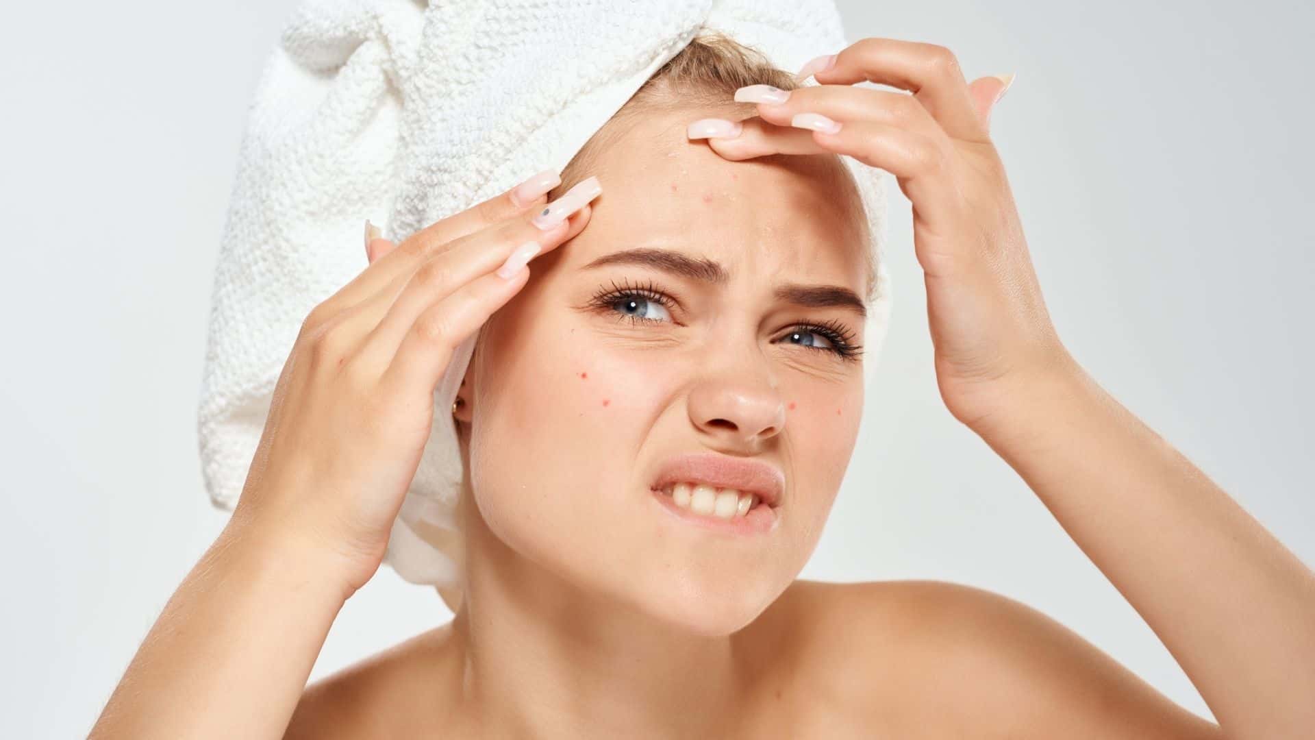 Does Dandruff cause acne?