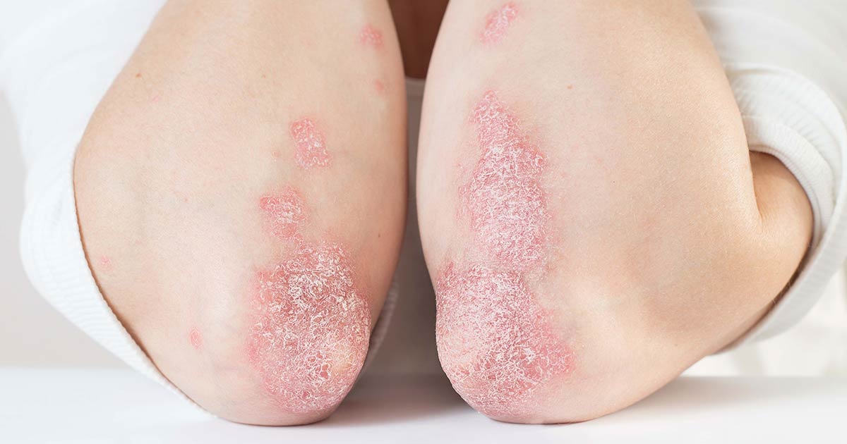 How Is Psoriasis Diagnosed