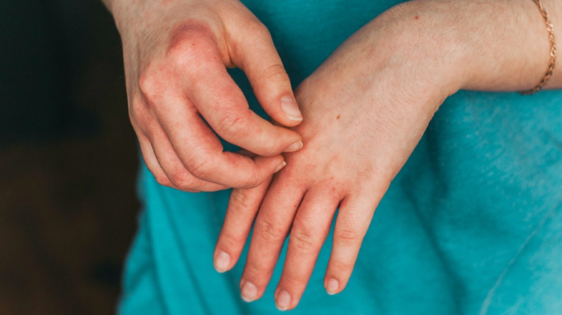 How To Prevent Eczema From Developing Again