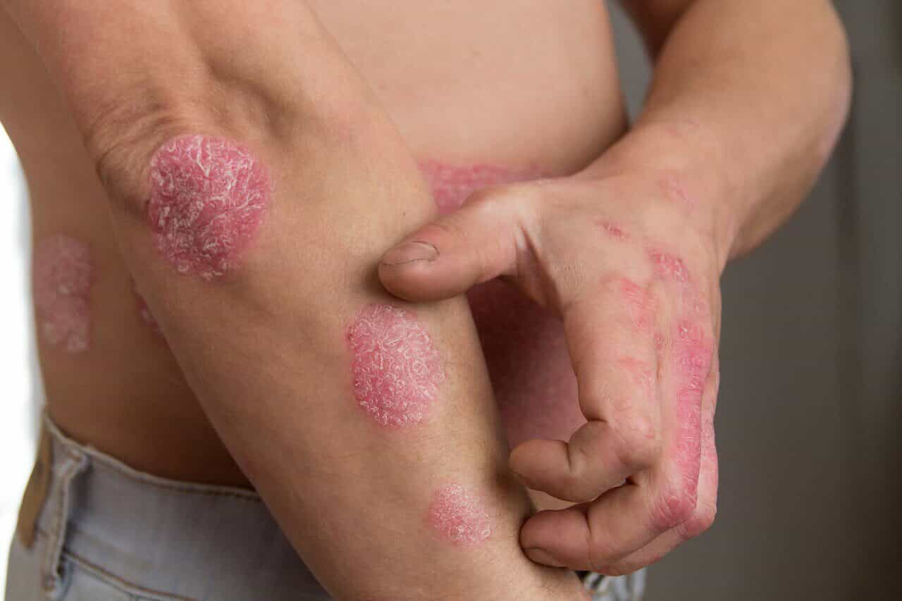 How To Treat Mild Psoriasis?