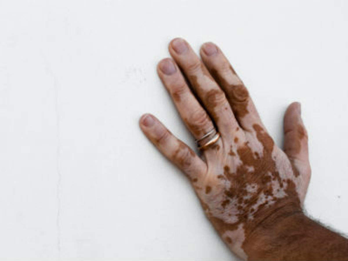 Is Vitiligo A Big Problem In India