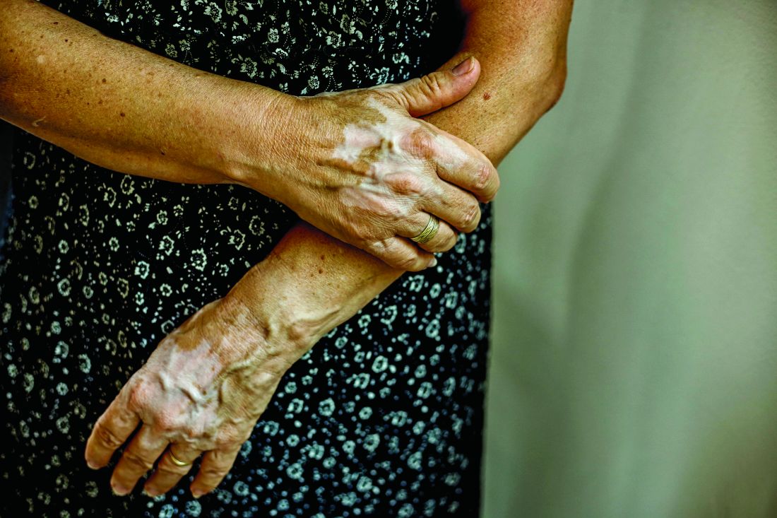 The Impact Of Vitiligo On The Patient's Life