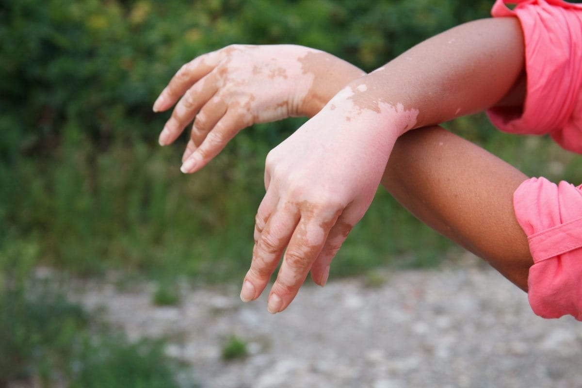 The Process Of Getting Diagnosed With Vitiligo