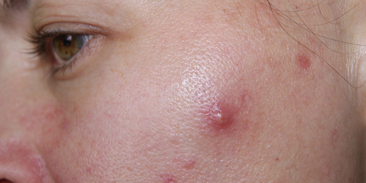 What Is Cystic Acne?