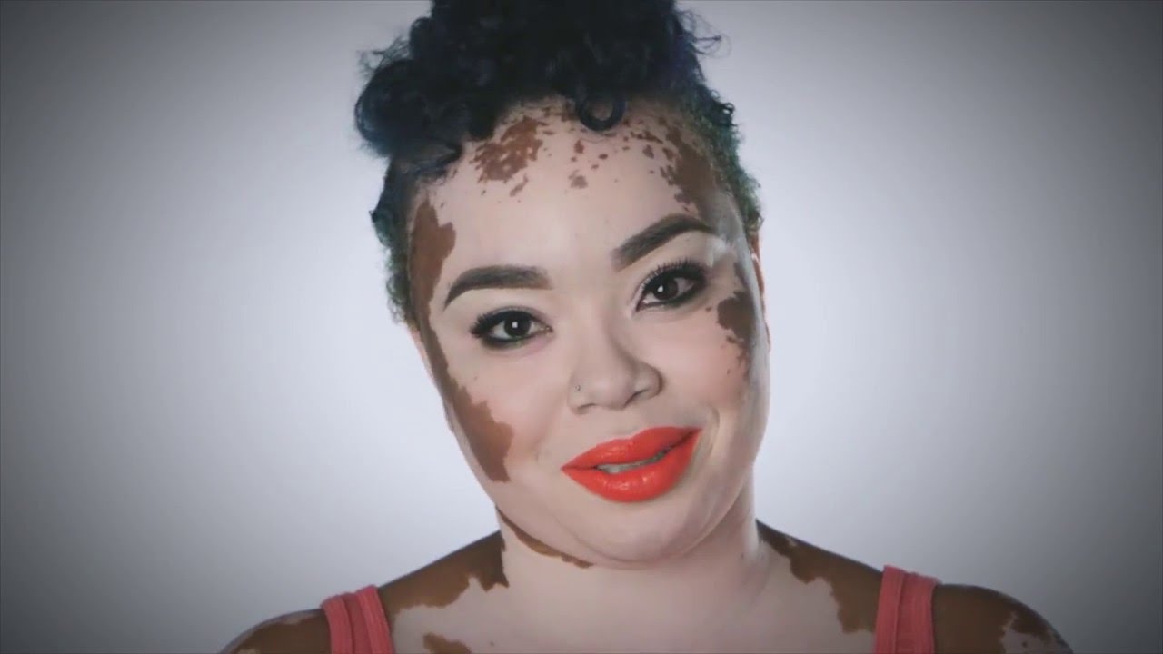Why Are vitiligo Patients Flocking To Homeopathic Skin Doctors?