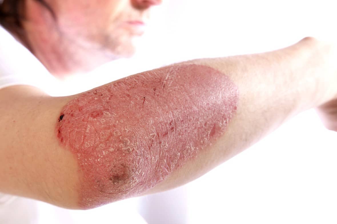 5 Reasons why your psoriasis is out of control