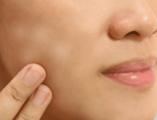 9 habits that can prevent you from getting white spots