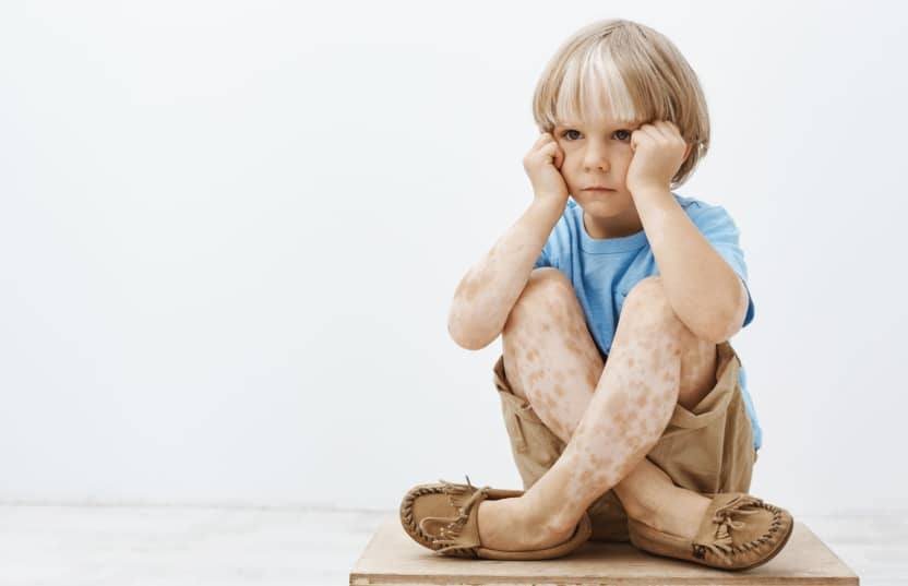 Can Children Get Vitiligo From Their Parents