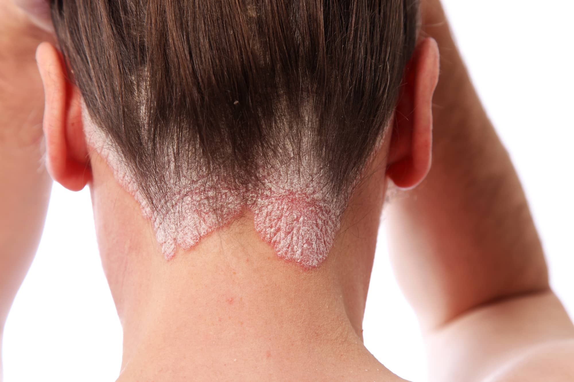 Do You Have Psoriasis? Here’s What You Need To Know About Homeopathy