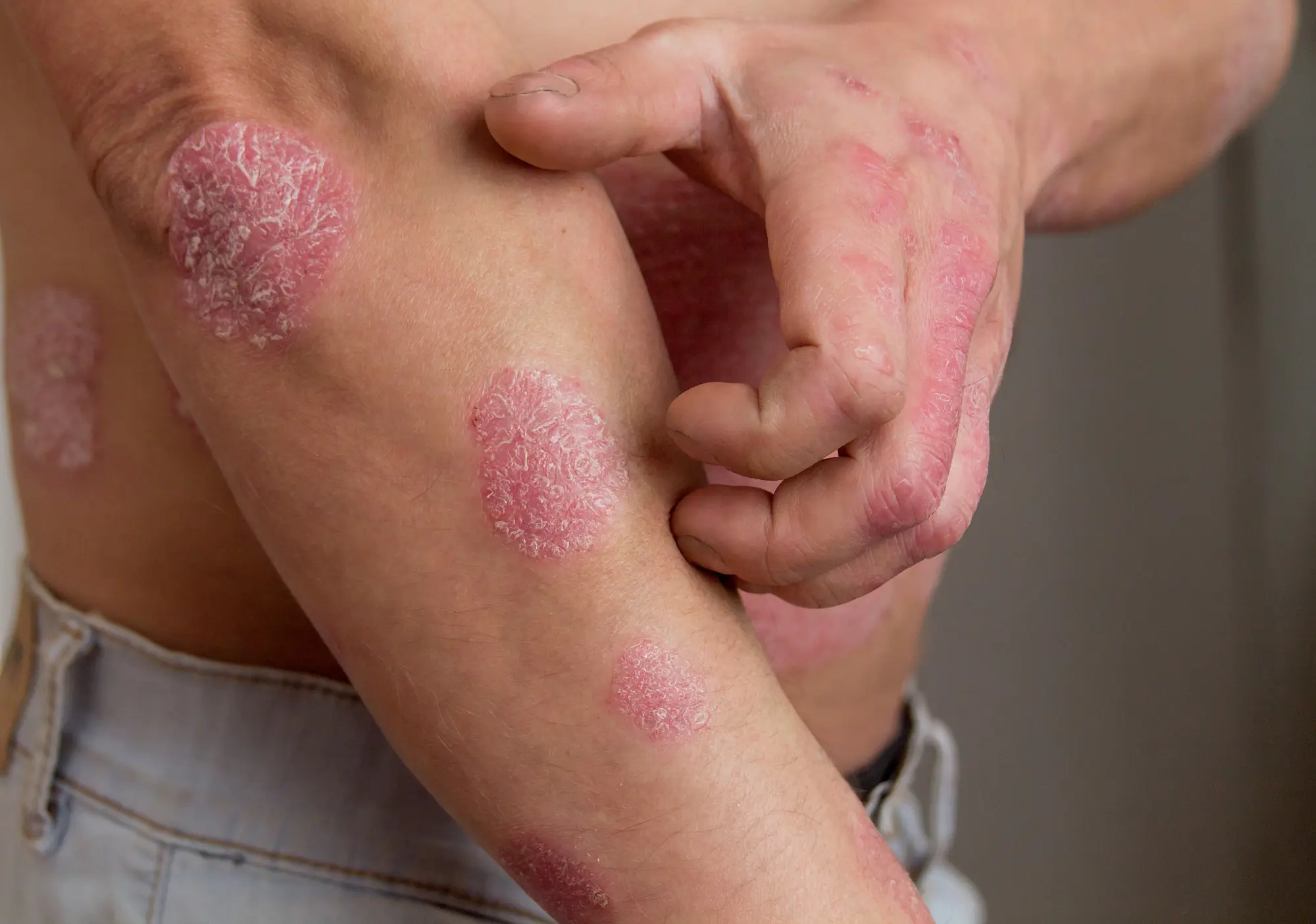 What's the best way to treat eczema from the inside out?