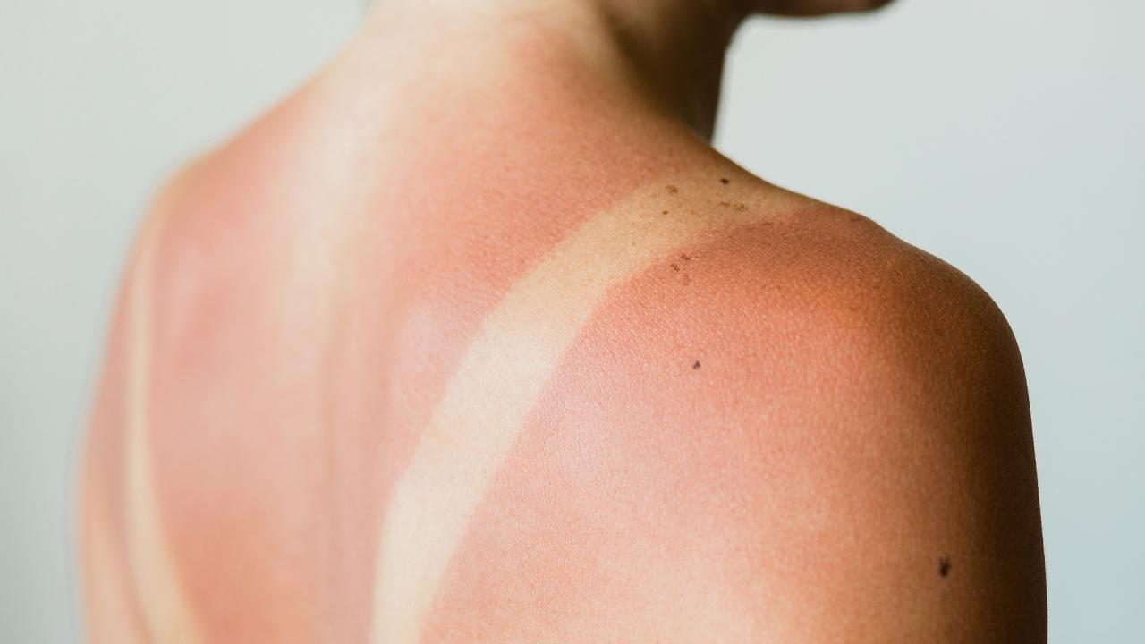 How Do Skin Doctors Treat Sunburn?