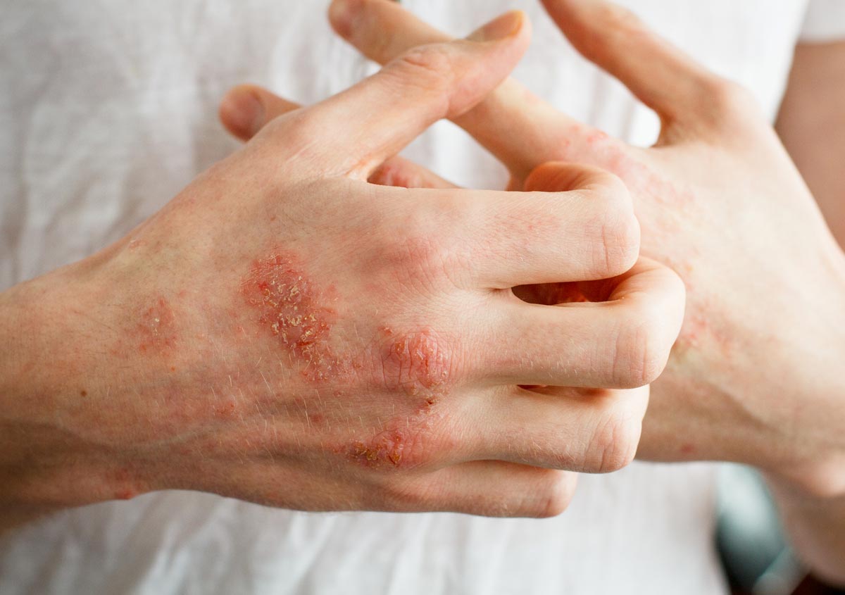 How To Choose A Homeopathic Solution For Eczema