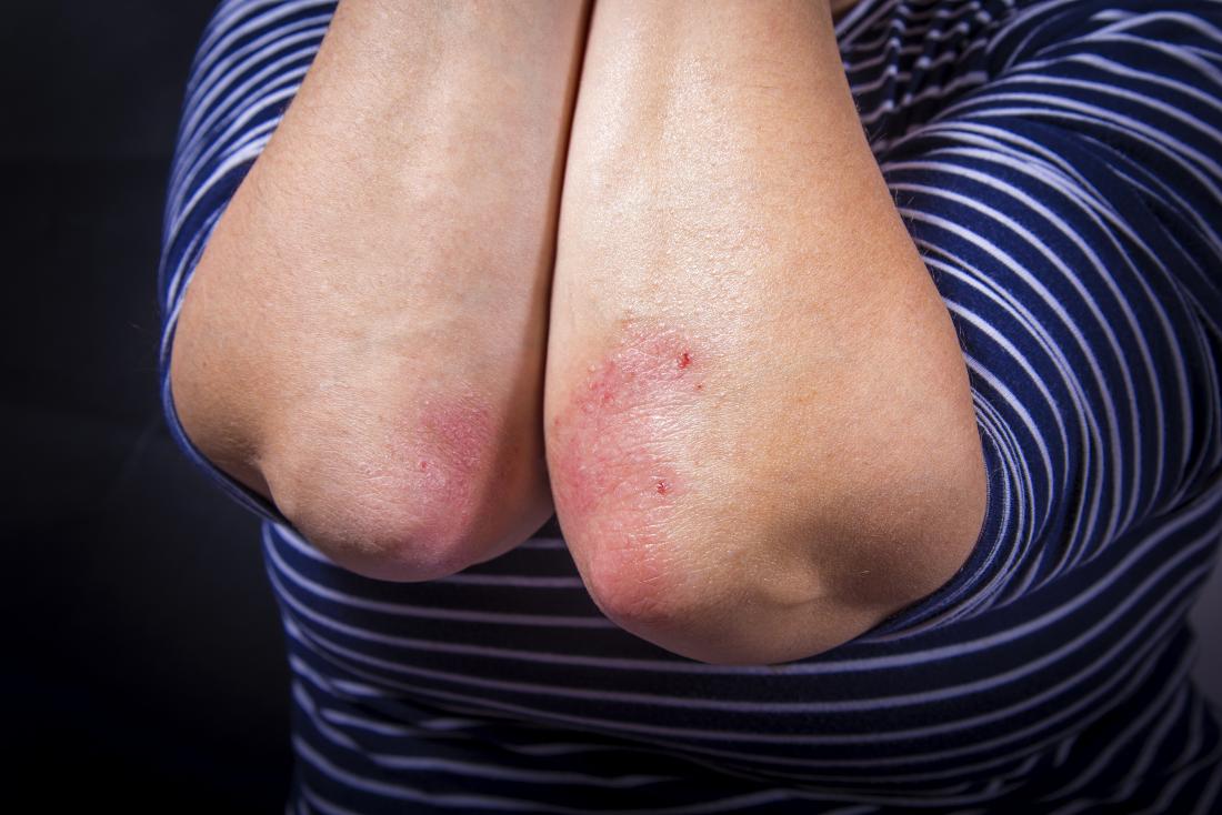 How Understanding The Patterns Of Your Psoriasis Can Help Treat It Faster?