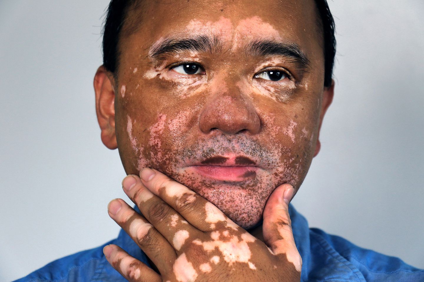 How can vitiligo affect your emotional well-being?
