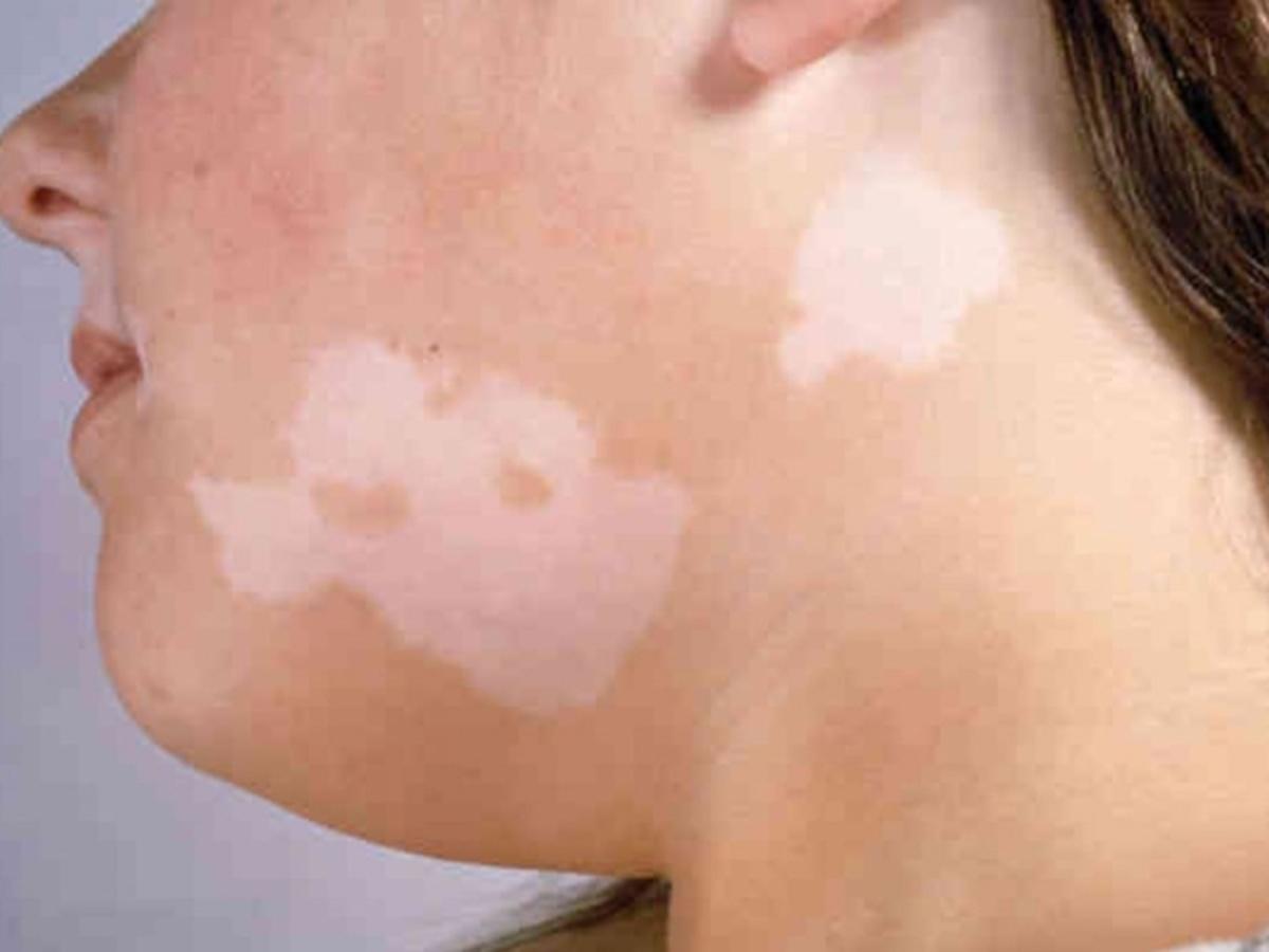How do I know if a 'white patch' is harmless or not?