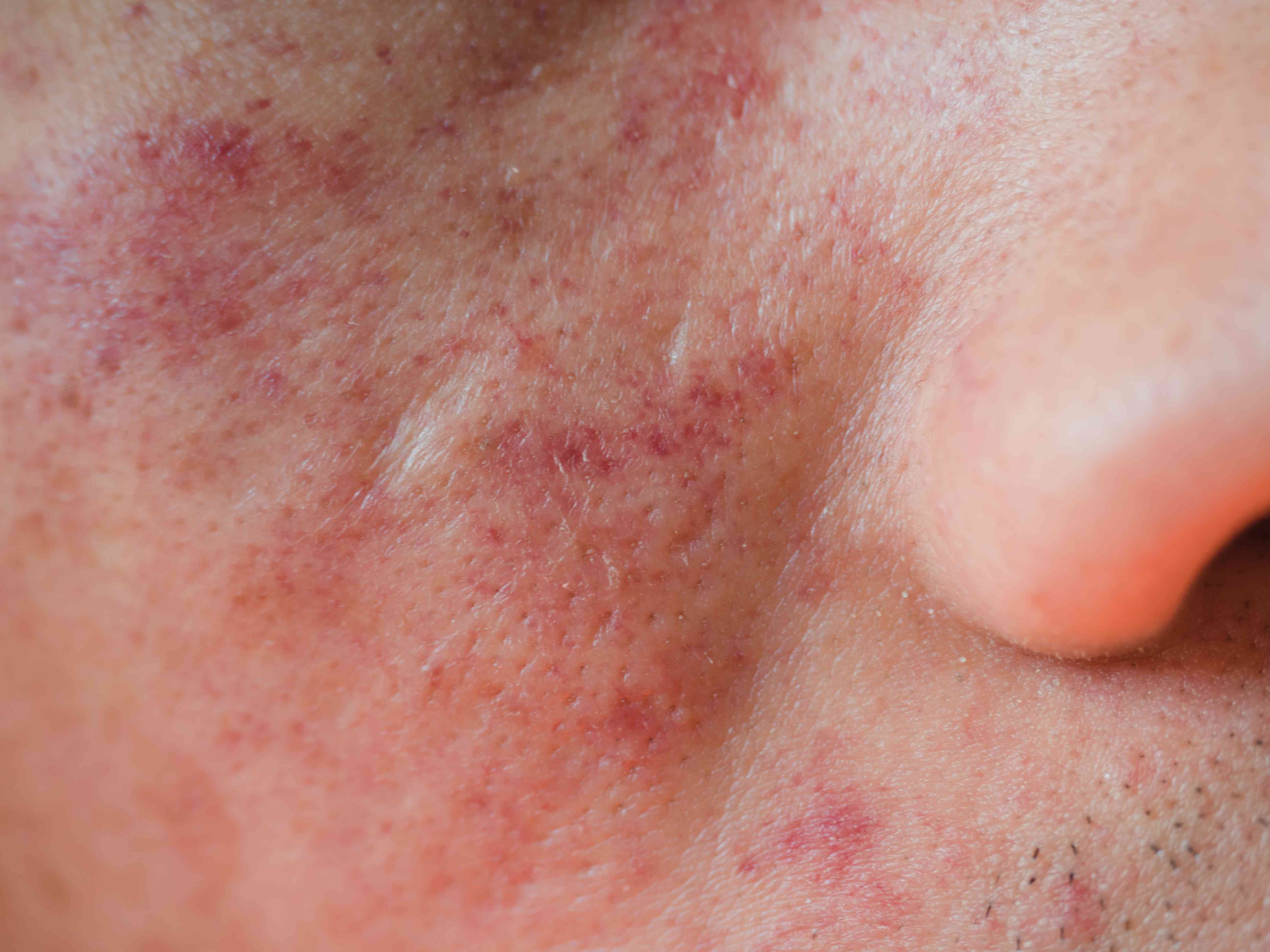 How do I know if my eczema is under control?