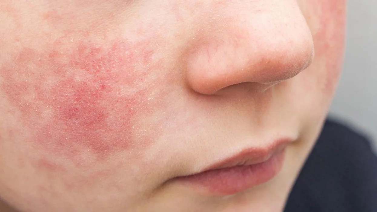 I want to go to a homeopath for my eczema. Should I?